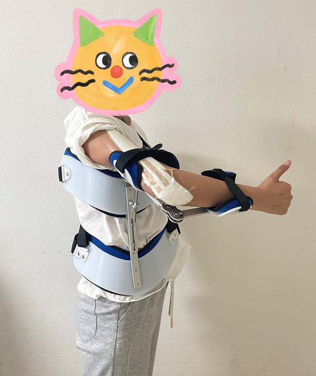 13歲少女患骨肉瘤面臨截肢，3D打印肱骨假體治療成功保肢